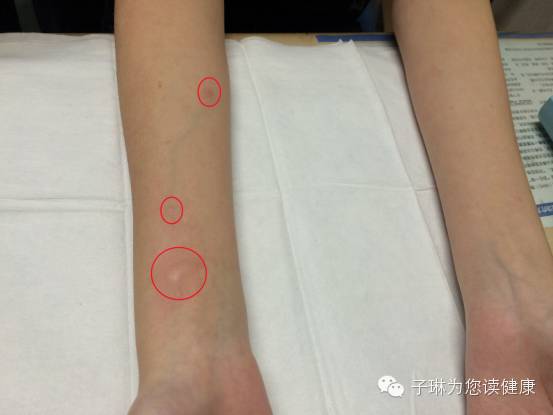 过敏性鼻炎像得了不治之症,过敏性鼻炎是不是什么大病