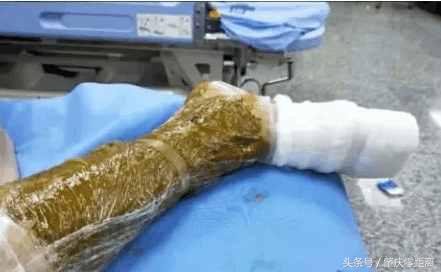 男子被毒蛇咬伤视频,有人被毒蛇咬伤现场应该如何处理