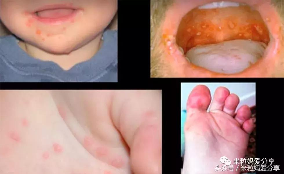 宝宝起疹的最佳治疗方法,孩子发烧后出疹怎么护理