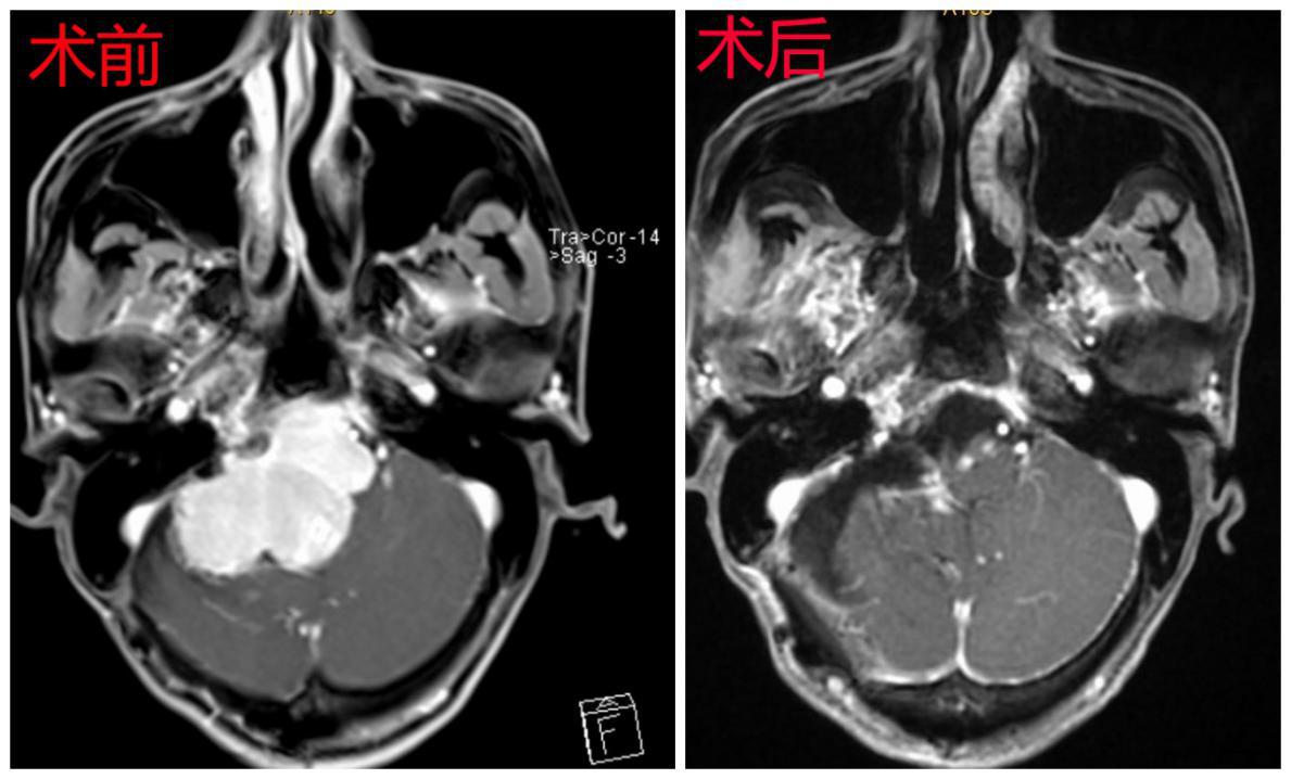 复杂脑肿瘤切除深圳二院脑科中心再创奇迹