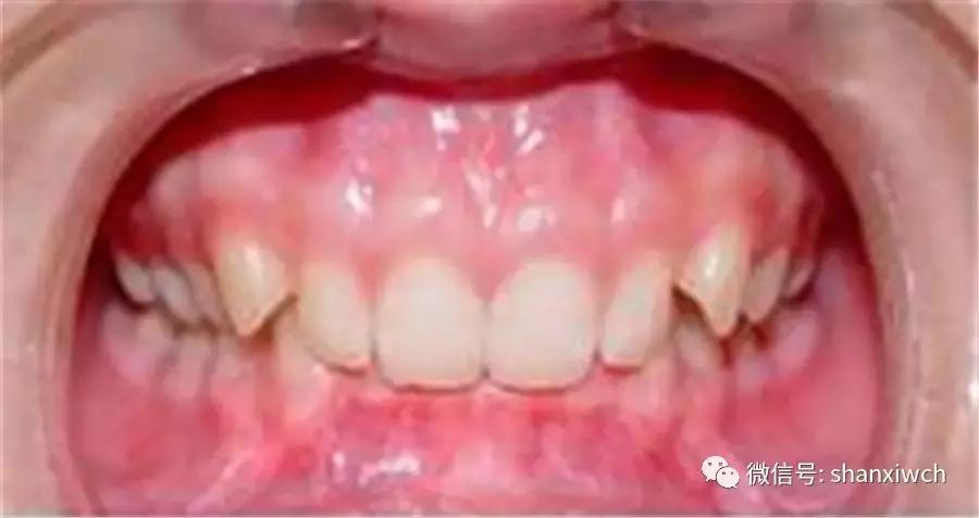 育儿知识关于牙齿,育儿知识幼儿牙齿敏感期