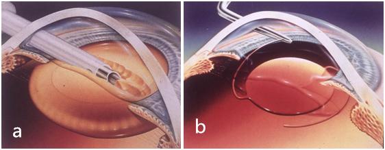 成熟后的白内障可以做手术吗,白内障成熟期才能做手术吗
