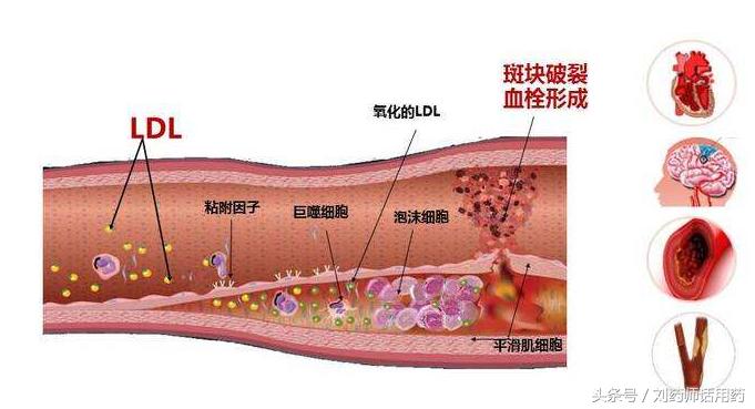 血脂lpa正常范围,血脂化验中lpa是什么意思