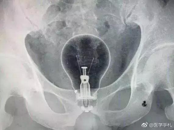 灯泡跑进肛门了！这个灯泡到底该如何取出？