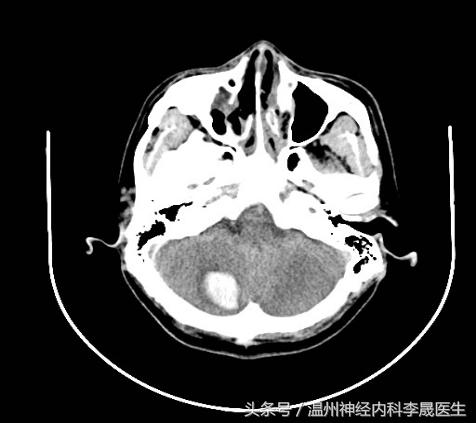 脑出血李医生,脑出血病例分析及答案