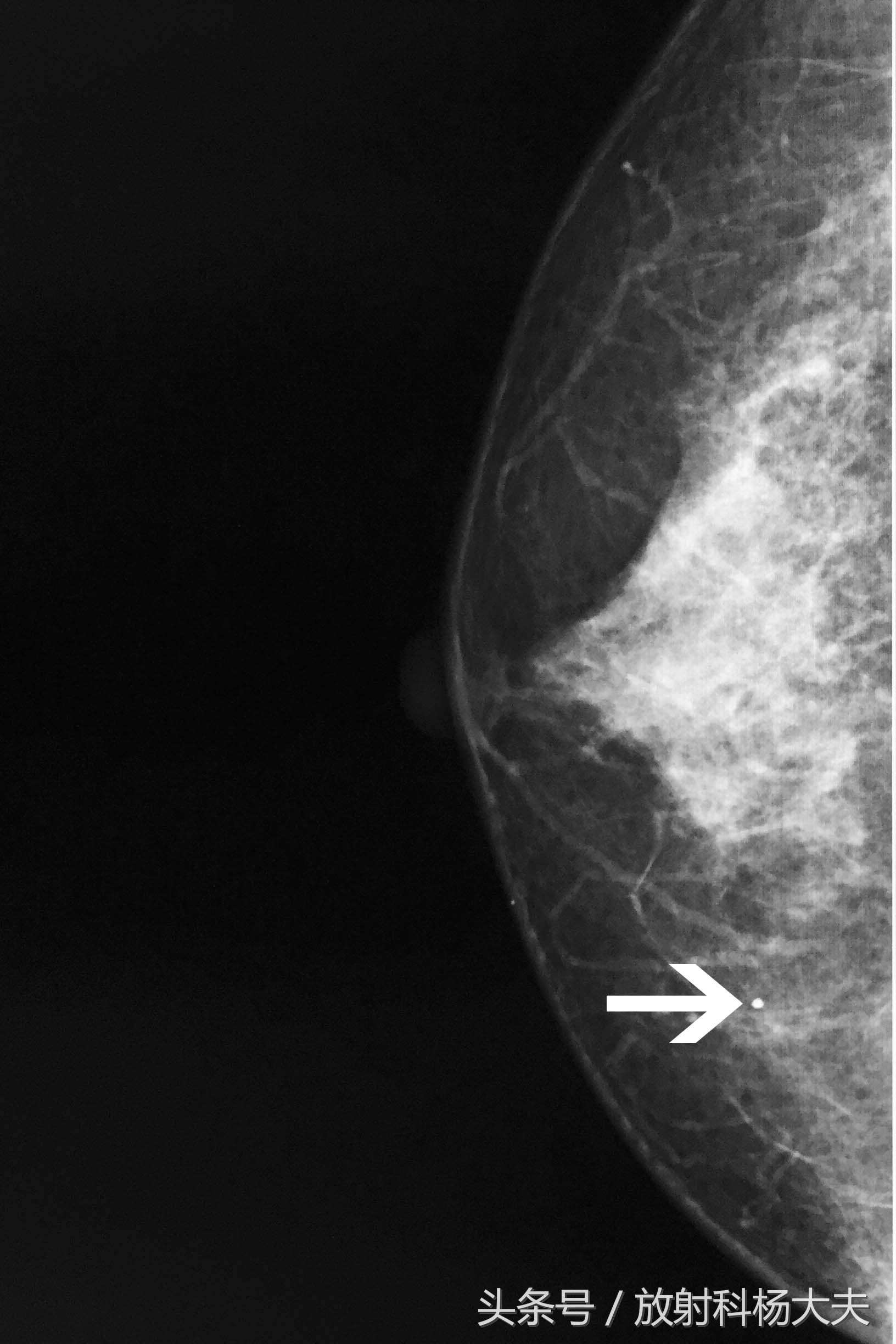 钼靶显示有钙化就是癌症吗,钼靶检查说是钙化和增生