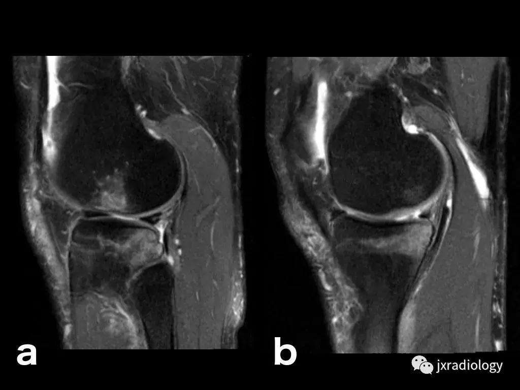 膝关节骨髓水肿疼痛特点,膝关节骨髓水肿的临床表现