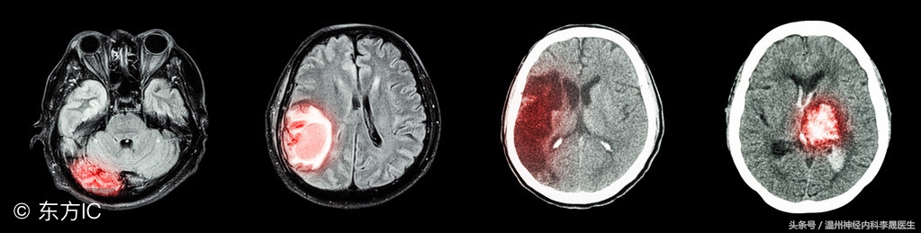 简述脑出血的内科治疗,脑出血中医解析
