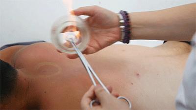 拔火罐减肥的原理及危害有哪些,拔火罐可以祛湿气减肥