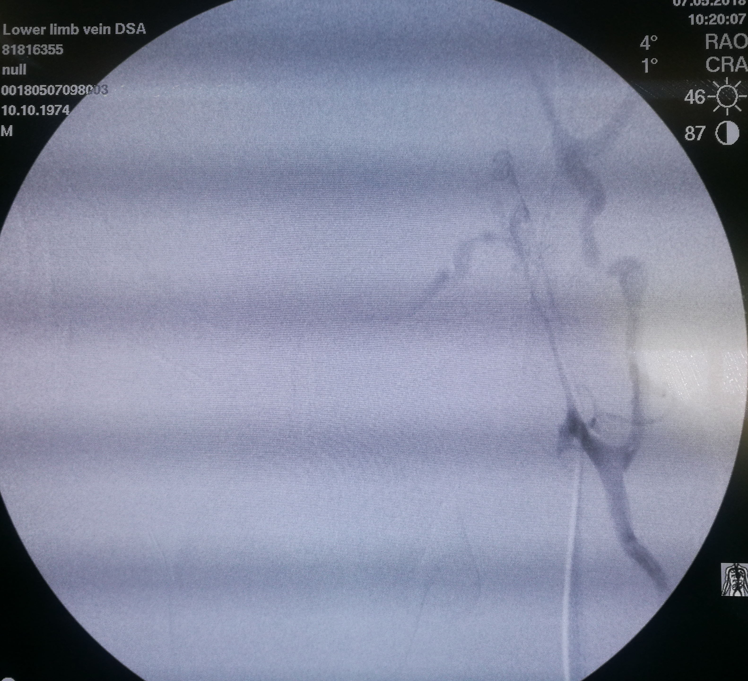 年纪轻轻怎么会一条腿反复血栓,年龄大了得了腿血栓怎么办