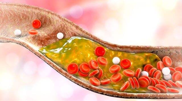 甘油三酯高到多少会引起动脉硬化,甘油三酯超过多少会造成动脉硬化