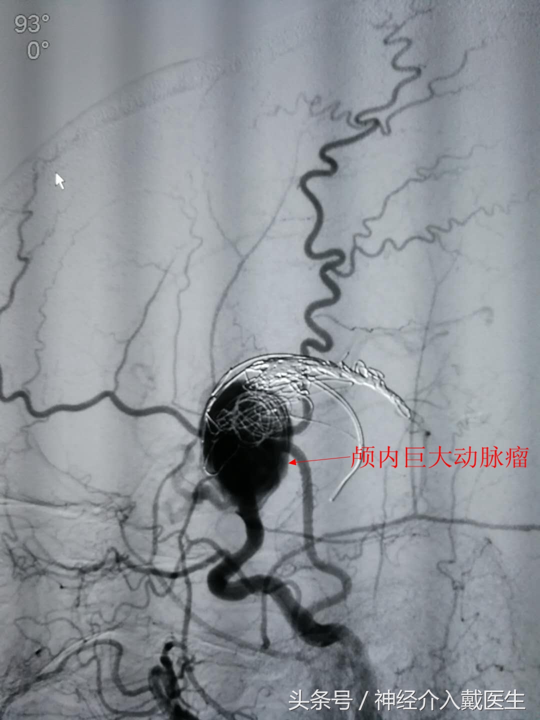 关于动脉瘤的治疗有几种方法,颅内动脉瘤的最新指南和共识