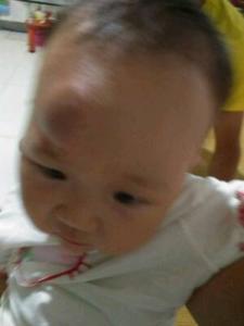 宝宝额头摔大包怎么判断孩子没事,宝宝额头摔个大包怎么处理