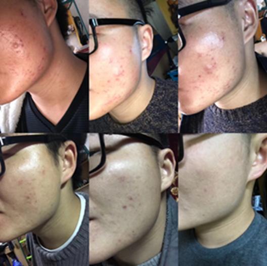 仔细看完他的经历，痘痘*疮痤**一去不复返！