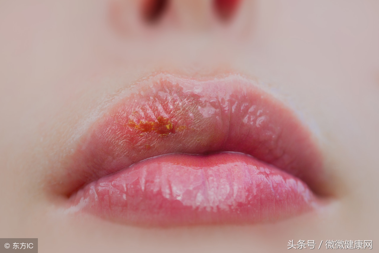 人体火气重用什么可快速降火,体内火气重的表现症状怎么治疗