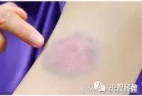 健康之路伤口处理方法,健康之路致命的伤口