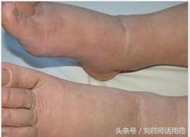 吃地平类的高血压药会引起水肿吗,高血压吃地平片浮肿改什么药