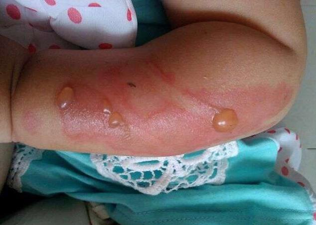 宝宝二度烫伤后期怎么好得快,宝宝二级烫伤多久可以恢复到正常