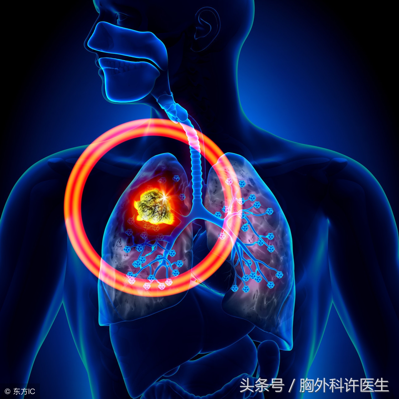 肺癌治疗仪器,肺癌手术器械