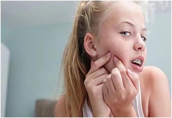 挤痘痘留了痘疤怎么办,挤痘痘留疤痕怎么消除