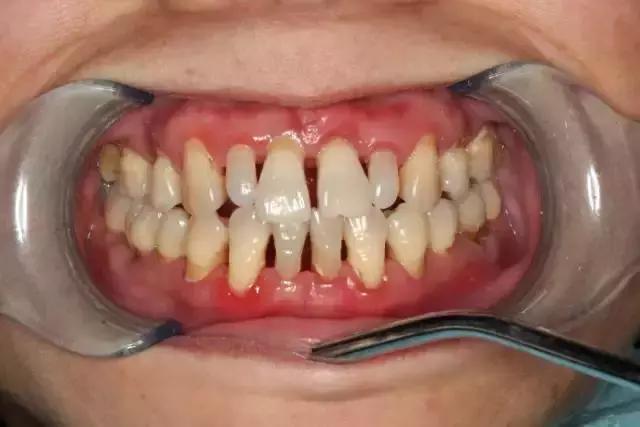 牙齿与牙龈缝处发黑一碰就出血,远离牙龈出血的一点小科普