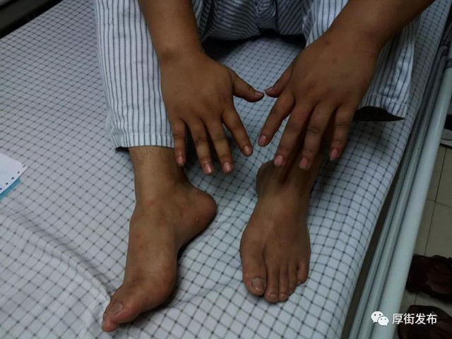 被蚂蚁咬保命,男子不慎被蚂蚁咬