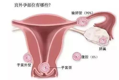 未婚女性左下腹痛,未婚少女下腹阵痛