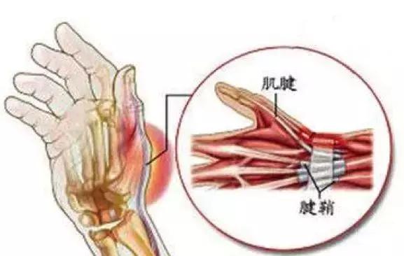 产后手腕疼妈妈要当心腱鞘炎,产后手腕疼当心抱孩子抱出腱鞘炎