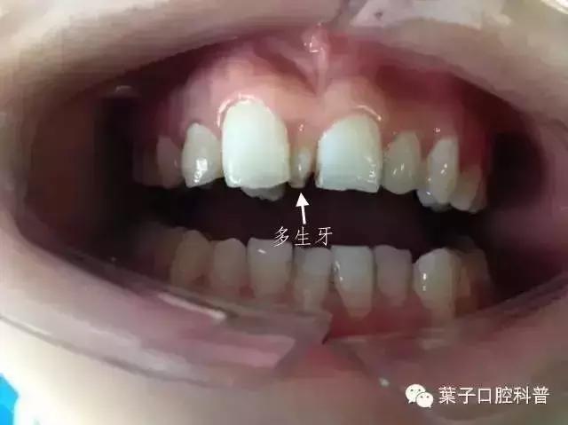 口腔科普儿童换牙常识,儿童换牙后牙缝大需要做矫正吗