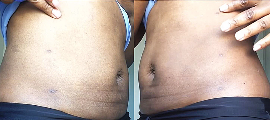 吸脂减肥手术亲身体验,胖女孩瘦身成功后怎么办