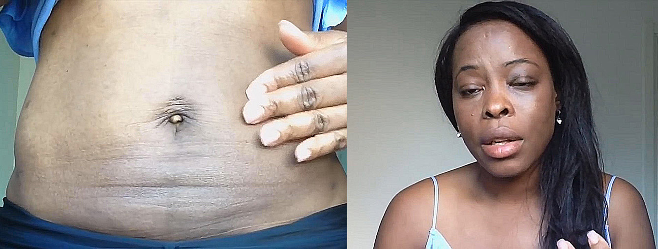 吸脂减肥手术亲身体验,胖女孩瘦身成功后怎么办