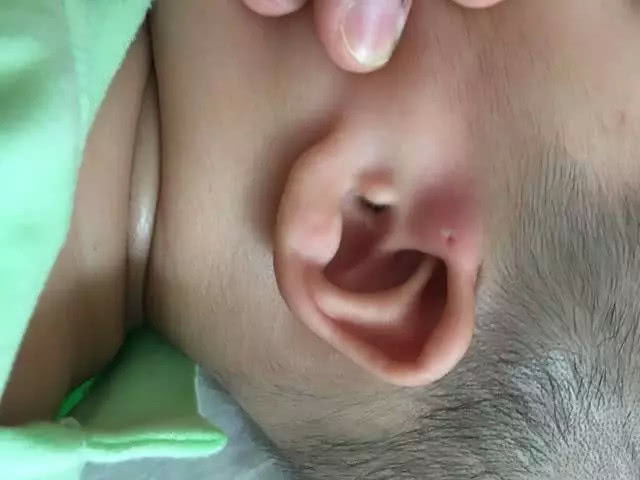 宝宝耳朵有个小洞是什么福气,孩子耳朵上有个富贵洞