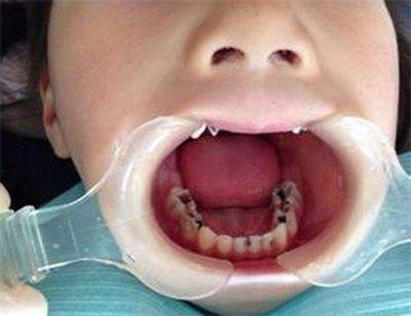 孩子牙疼痛哭,5岁儿童牙疼一直哭