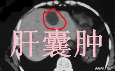 囊肿跟肿瘤的影像学区别,囊肿和肝癌的关系