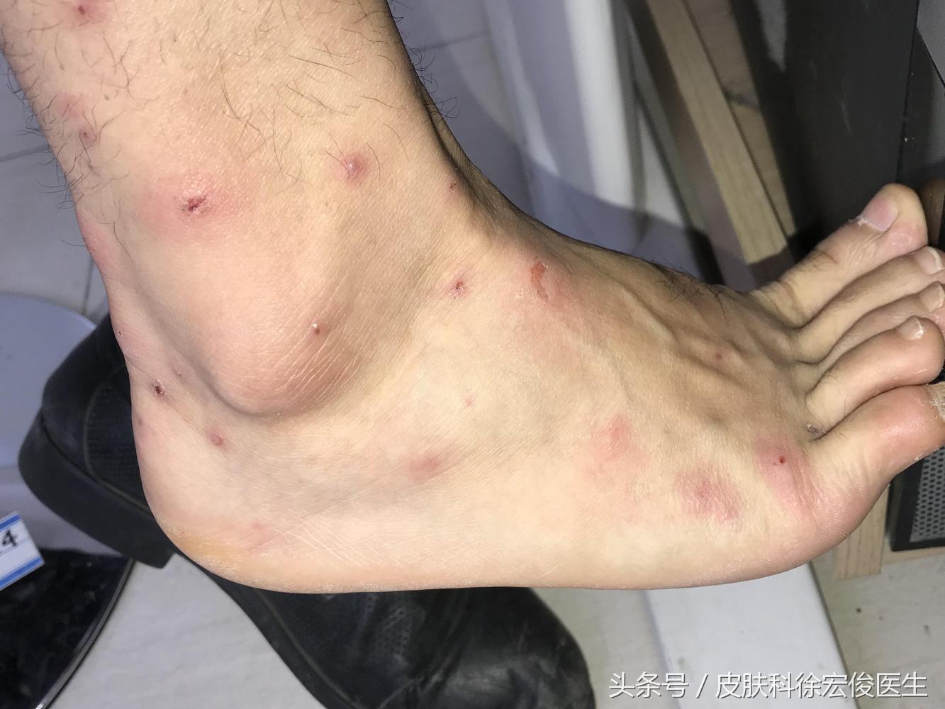 臭虫咬人身上起疙瘩怎么治,床上臭虫多晚上咬人会很痒吗