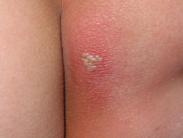 红包有不好的含义吗,额上长疱是什么原因