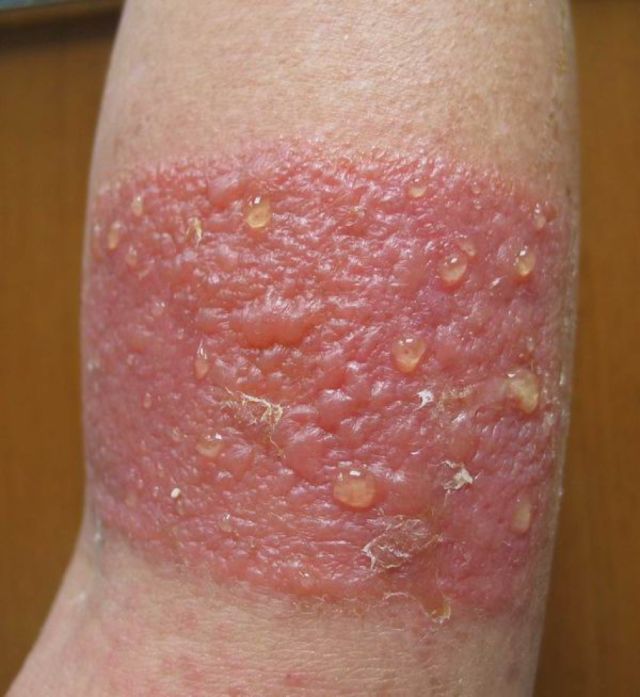 红包有不好的含义吗,额上长疱是什么原因