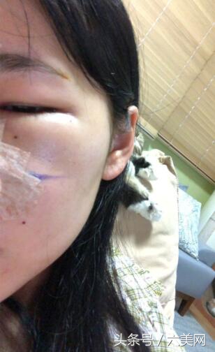 隆鼻后如何克服焦虑,隆鼻后前三天状态