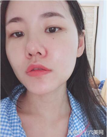 隆鼻后如何克服焦虑,隆鼻后前三天状态