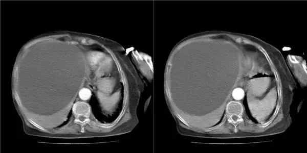 以为是肠胃小毛病没想到是癌症,开始以为是胃疼后来才发现是结石