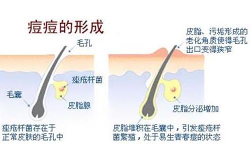 后背脖子上起很多痘痘怎么消除,脖子上长了一个大痘痘怎么消除