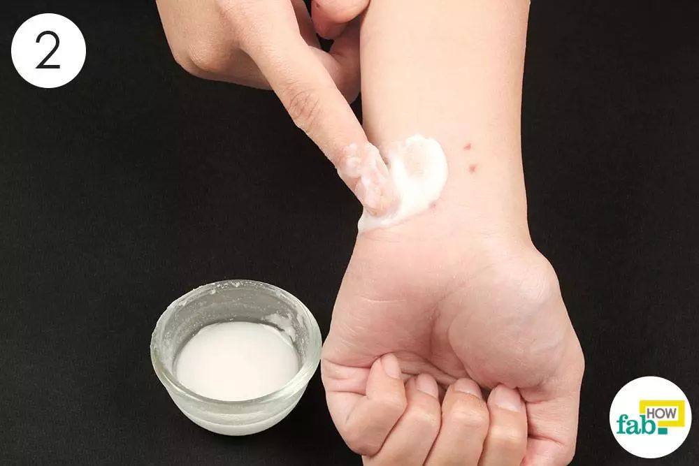 小儿被蚊子咬了怎么消肿止痒最快,被蚊子叮咬后用盐能快速止痒