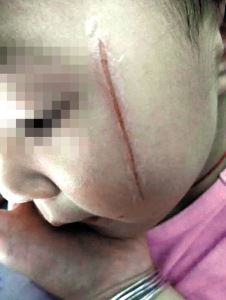 小孩脸让同学划伤用报警吗,幼儿园里小孩脸被同学划伤怎么办
