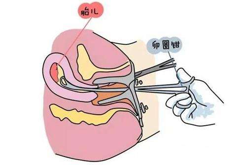 女性的一生可以承受几次流产?超过这个次数,身体就要毁了