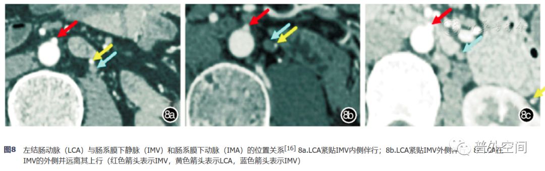 腹腔镜完整结肠系膜切除术相关血管变异与术中出血的应对措施（上）