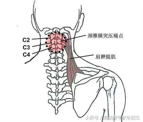 李医生解析颈椎病手法复位,李医生颈椎病最好的锻炼方法