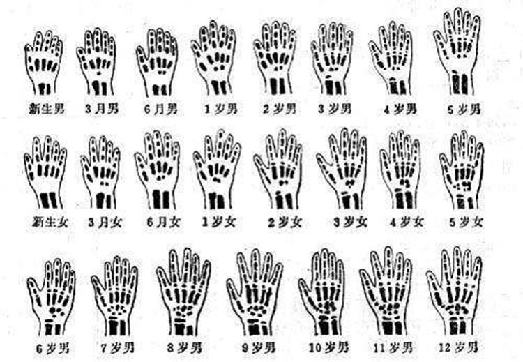 孩子矮小因发育晚？该了解下骨龄检测了