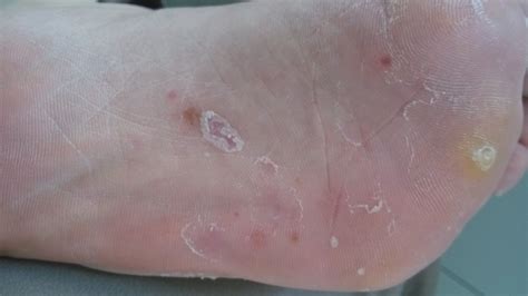 脚气引起皮质增厚怎么用药,脚气用碘伏之后可以用药吗