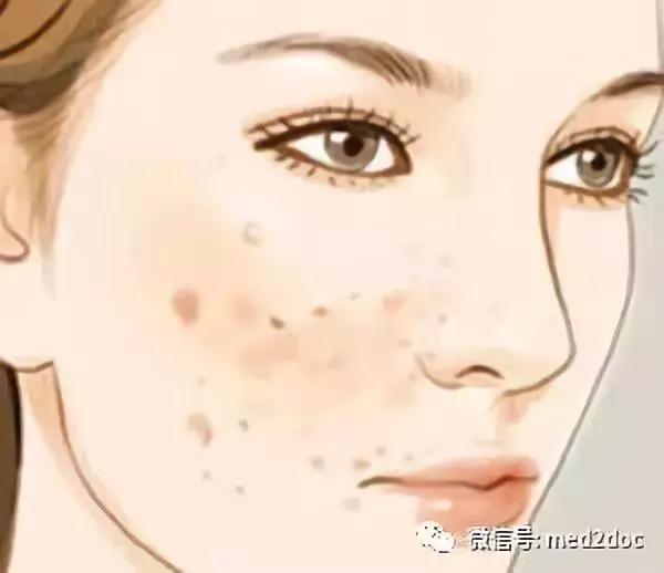 痘痘分几种而且该用什么方法去掉,脸上的痘痘能乱挤吗