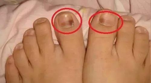 跑步脚上起血泡长什么样子,跑步大脚趾起水泡是怎么回事